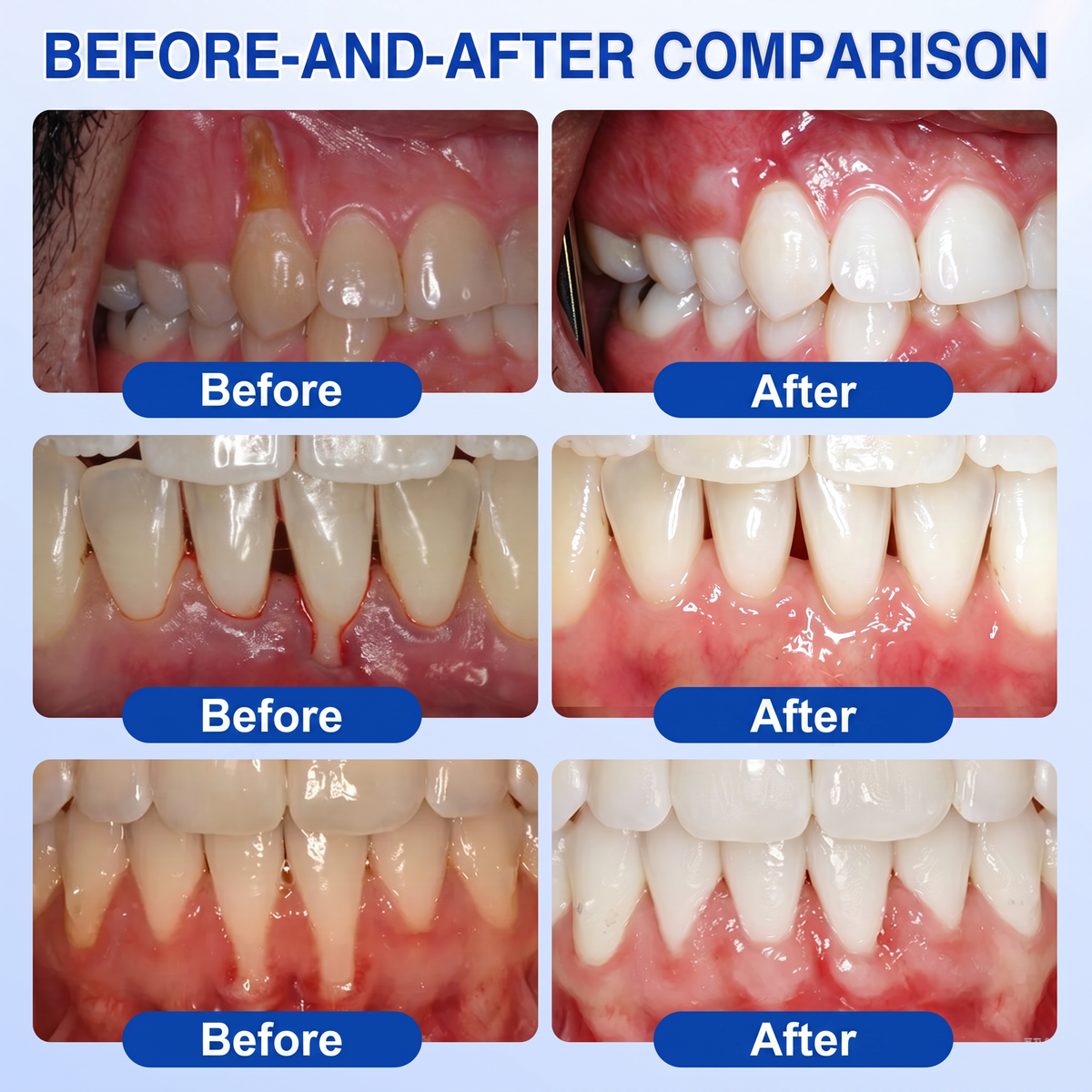 🇪🇸Pureluxo® 🦷Gel de reparación periodontal GumRevive🌿