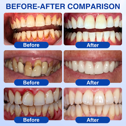🇪🇸Pureluxo® 🦷Gel de reparación periodontal GumRevive🌿
